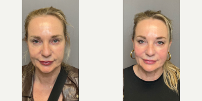 45-54 year old woman treated with Nonsurgical Facelift, Liquid Facelift, Restylane, Sculptra, Dermal Fillers, Dysport - Sculptra, Restylane and dysport