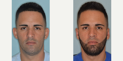 25-34 year old man treated with Ear Surgery - Before and after bilateral otoplasty