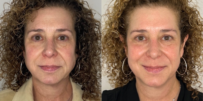55-64 year old woman treated with Microneedling RF, CO2 Laser - 60 year old after 2 sessions of RF Microneedling + 2 CO2 micropeel