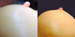 Nipple Reduction - 	Nipple reduction