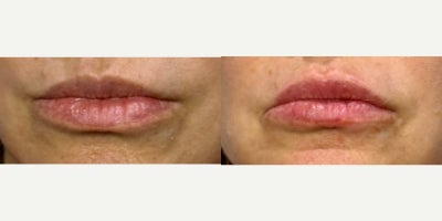 35-44 year old woman treated with Juvederm - Lips after injecting 1 syringe of Juverderm