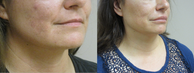 Juvederm lip filler - Patient wanted to have fuller more youthful looking lips. Two syringes of Juvederm Ultra XC were injected.