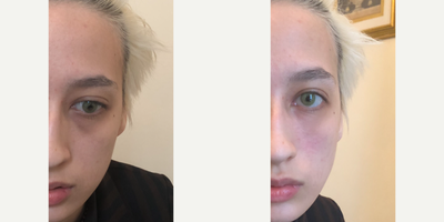 18-24 year old woman treated with Teosyal - Before and after photos of Tear Trough treatment with Teosyal filler
