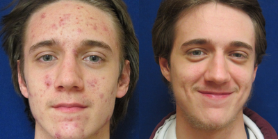 17 year old man treated with Isotretenoin. - This young man was on a course of Isotretenoin, a series of Lasers and Topicals, as recommended by Dr. Comite for his acne.&nbsp;