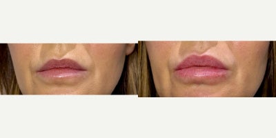 55-64 year old woman treated with Juvederm - Non-Surgical Lip Augmentation using 1 syringe of Juvederm