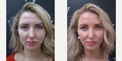 Dermal fillers correction, Dr Mohan reversing the unwanted result - Dr Sach Mohan used Hyalase (Hyluronadase) to correct excessive dermal fillers with a series of small, precise injections into specific areas where they were required: the nasolabial fold and lips