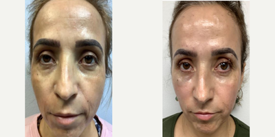 45-54 year old woman treated with Dermal Fillers, Cheek Fillers, Juvederm, Radiesse - I did her cheek with 2 juvaderm, 1 radiesse nasolabial