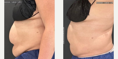 Woman treated with CoolSculpting Elite - Obsessed with this amazing improvement after just 1 treatment of Coolsculpting Elite to the abdomen and 12 weeks of medical weight loss.