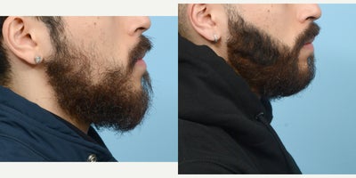 18-24 year old man treated with Hair Loss Treatment - Beard Transplant to fill in patches on cheeks.
