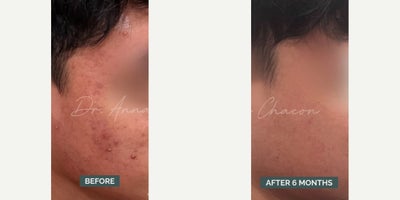 Man treated with Accutane - Man treated with Accutane