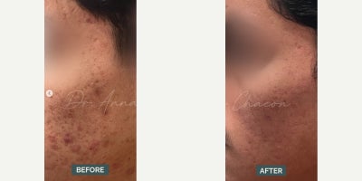 Man treated with Accutane - This patient's journey on Accutane has been transformative. At the 6-month mark, you can see a significant improvement in their skin.