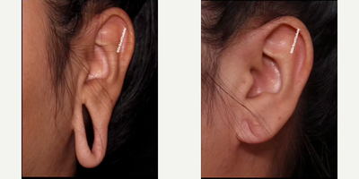 Woman treated with Ear Surgery - 