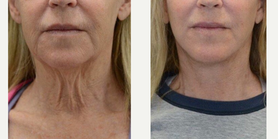 55-64 year old woman treated with Lifestyle Lift - 64 year old female wants rejuvenation of lower face and neck.The package includes Cynosure Smart Lipo for collagen building and platysmaplasty. Procedures were performed with local anesthesia and oral sedation.