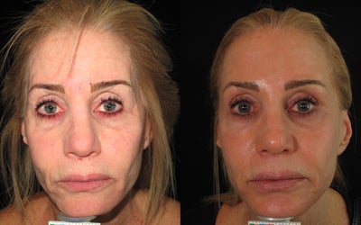 Artefill, Juvederm, Botox - Liquid Face Lift - Artefill, Juvederm, Botox, Liquid facelift