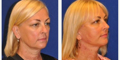Woman treated with Neck Lift - Neck Lift