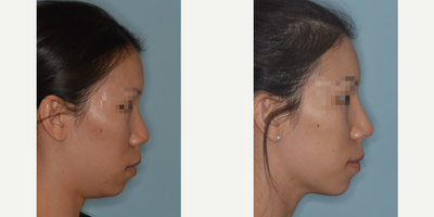 18-24 year old woman treated with Asian Rhinoplasty - Asian female patient who desired to have refinements to her tip and bridge. The bridge was refined by narrowing and raising the bridge of her nose. Bridge refinement was achieved with osteotomies and augmentation using temporalis fascia and diced cartilage grafting. The tip was narrowed and refined using a tip graft.