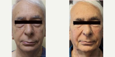 75 and up year old woman treated with Juvederm, Volbella, Voluma, Restylane, Restylane Contour - 4D Under Eye Lift - Treatment of dark circles & bags under eyes and cheek restoration with Belotero, Restylane, Volbella and Voluma