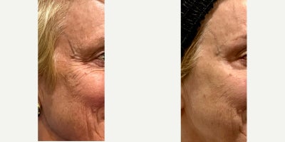 65-74 year old woman treated with Botox - 24 units of Botox to correct crows feet
