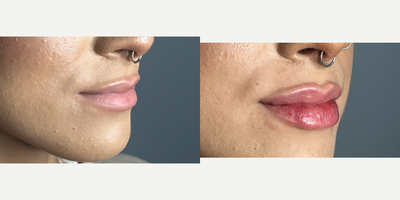 25-34 year old woman treated with Lip Fillers, Revanesse - Patient was treated with Revanesse Lips in Lips