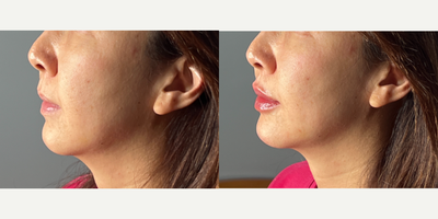 45-54 year old woman treated with Lip Fillers, Chin Filler, Juvederm, Revanesse - Patient was treated with Juvederm Volux in chin and Revanesse Lips in Lips