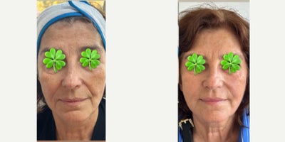 55-64 year old woman treated with Nonsurgical Facelift - Due to fast weight loss, the patient had a volume loss. Also she has a skin laxity condition related to her age. The treatment is obtained is liquid face lift.