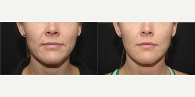 25-34 year old woman treated with Restylane Lyft - 34 year old female received Restylane Refyne, Restylane Defyne and Restylane Lyft to the nasolabial folds and cheeks; photos depict the patient's results 1 week post-treatment.