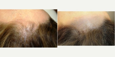55-64 year old woman treated with PRF Treatment - 55-64 year old woman treated with PRF Treatment for hair loss