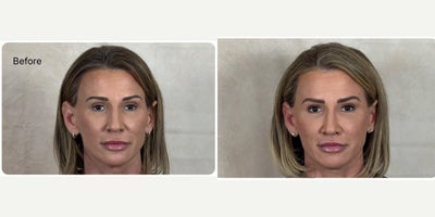 45-54 year old woman treated with Lip Lift, Lip Surgery, Lip Repositioning - Lip lift performed in combination with mini facelift and facial fat transfer to restore a more youthful, balanced, and naturally rejuvenated appearance. Notice the improvement in upper tooth show, lip shape, facial harmony, and overall softness of facial aging while maintaining a natural result.