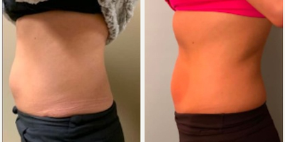 Woman treated with Cryoskin - Woman treated with Cryoskin