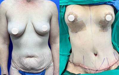 Woman treated with Mommy Makeover - Woman treated with Mommy Makeover
