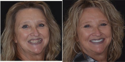 55-64 year old woman treated with Dental Bridge, Porcelain Veneers - Zirconia Bridges and Porcelain VeneersThis patient underwent a transformative smile makeover with a combination of Zirconia bridges and porcelain veneers. Zirconia bridges were used to replace missing teeth, ensuring exceptional durability, strength, and a natural look. Porcelain veneers were crafted to enhance the shape, color, and alignment of the remaining teeth, providing a bright and harmonious smile. Together, these treatments deliver both aesthetic beauty and functional improvement, tailored to the patientsneeds.