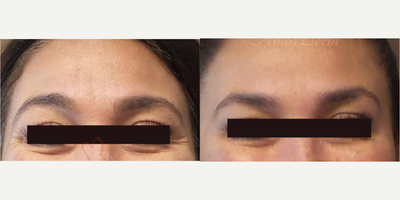 45-54 year old woman treated with Botox, Dysport, Jeuveau, Xeomin - Botox injection for treatment of crow's feet & lines & wrinkles in forehead & between eyebrows (can also be done with Dysport, Jeuveau or Xeomin)