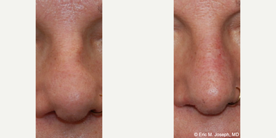 35-44 year old woman treated with Silikon 1000 - Our lovely patient never had a rhinoplasty. She was dissatisfied with the appearance of the indentation of her left bridge, and excessive nostril show. You can see a straighter and more pleasing nasal appearance after her second treatment with Silikon-1000, a permanent soft tissue filler well suited for permanent non-surgical nose job treatments. There is never a risk of necrosis, embolism, stroke, or blindness with Silikon-1000. Those complications are associated with temporary gel fillers like HA.