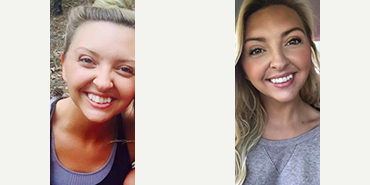 Straighten your teeth without braces - Photo provided courtesy of SmileDirectClub.