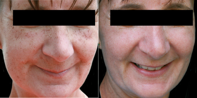 45-54 year old woman treated with Skin Lightening - BBL Forever Young Fotofacial, IPL