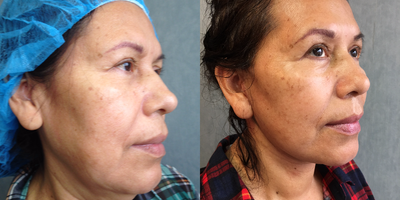 45-54 year old woman treated with Lower Face Lift - full face and neck lift natural results no bruising tumescent technique with sedation only