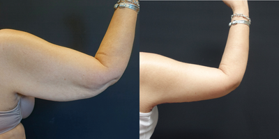 45-54 year old woman treated with Arm Lift - The patient underwent a brachioplasty (arm lift) to remove the excess fat and skin from around her arms. The images show her results at six weeks.