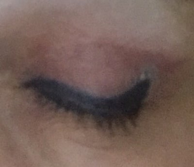 Eye liner tattoo. How can I remove it? (Photo) Doctor ...