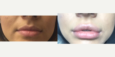 18-24 year old woman treated with Lip Augmentation - This young and pretty woman wanted her lips more plump. We injected 1 mL of Restylane.&nbsp;