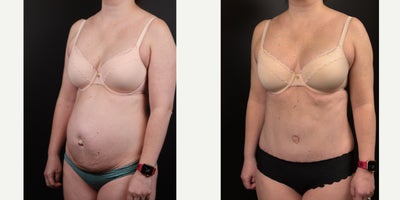 35-44 year old woman treated with Tummy Tuck, Diastasis Recti Repair, Umbilical Hernia Repair, Liposuction - This 38 year old woman is 5'3 and 138 pounds. She has been pregnant 5 times, had 4 children, 3 of them by C-section. She has a wide diastasis recti, (separation of the abdominal muscles), and even ventral and umbilical hernias. She had an abdominoplasty with repair of rectus diastasis and hernias, as well as some liposuction of the flanks.