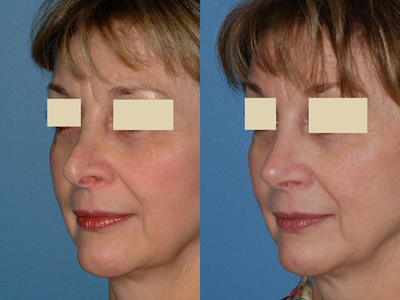 Revision Rhinoplasty - 
	I corrected this patient's distorted nasal tip and polly-beak deformity by performing a revision rhinoplasty with ear cartilage grafts.
