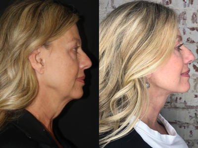 45-54 year old woman treated with Facelift and Neck Lift - This patient travelledto have her procedure with me. She wanted to recapture a more refreshed youthful look, especially in her neck and jawline. It was essential to her that she look natural. She sent me these photos of herself 4 months after her Advanced SMAS Facelift (VIP Lyft ) and Neck Lift.