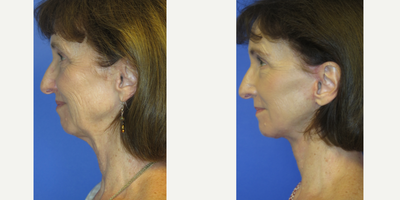 63 year old woman treated with Lifestyle Lift - 63 year old female seeking rejuvenation of her lower face and specifically her jowls, jawline, and neck. She also had her lower eyes and mouth treated with CO2. She had a lower facelift with neck lift under local anesthesia.