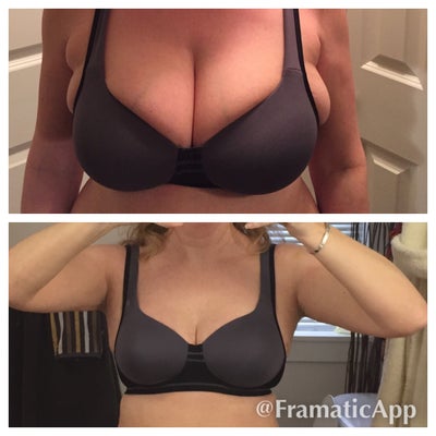 32 Year Old Mommy of 3. Size 44g Breast. Hoping for Large C to D 