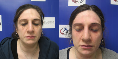 35-44 year old woman treated with Sylfirm X - Before and after 3 Sylfirm x treatments with exosomes. Patient has melasma.