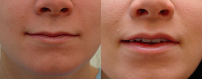 25-34 year old woman treated with Lip Surgery - Lip lift in office under local performed by removing the upper lip skin beneath the nose.