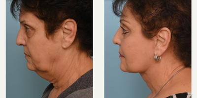 Woman treated with Facelift - Woman treated with Facelift