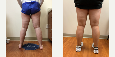 35-44 year old woman treated with EVLT, Sclerotherapy - Patient had an EVLT and 2 sclerotherapy treatments performed.