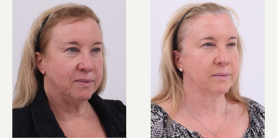 55-64 year old woman treated with BroadBand Light (BBL) - before and after 2 BBL treatments to address rosacea and uneven skin tone.