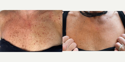55-64 year old woman treated with BroadBand Light (BBL), Moxi - Before and after 1 session of BBL & Moxi